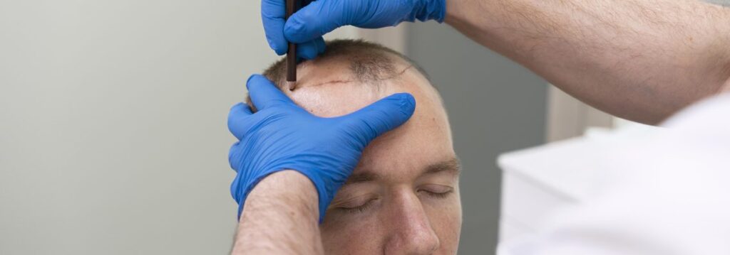 How to Select the Best Surgeon for Your Hair Transplant UK