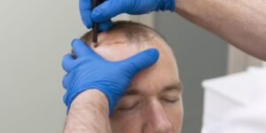 How to Select the Best Surgeon for Your Hair Transplant UK