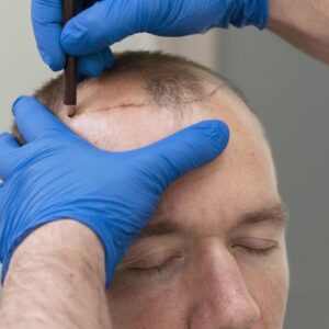 How to Select the Best Surgeon for Your Hair Transplant UK